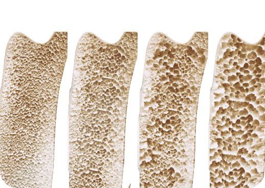 Bone mineral density