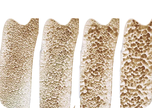 Bone mineral density